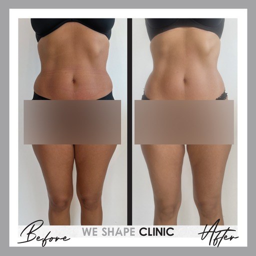 Abdominal Contouring — before and after at Weshape Clinic