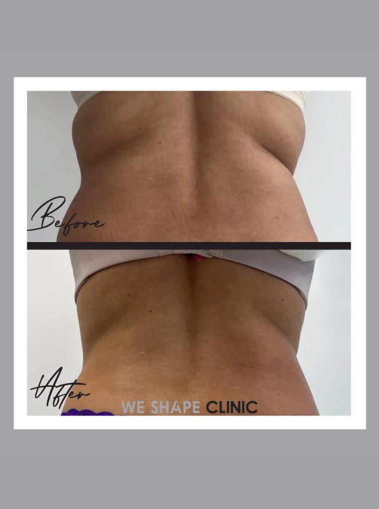 Love Handle Reduction — before and after at Weshape Clinic