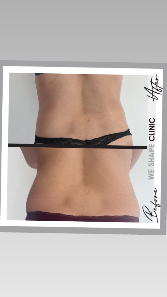 Waist & Back Contouring — before and after at Weshape Clinic